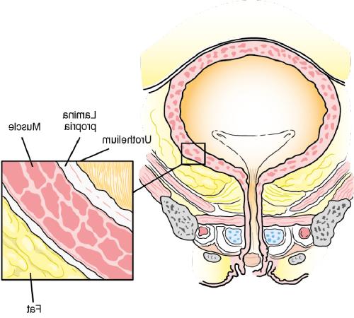 图示膀胱的内层，癌症往往从这里开始